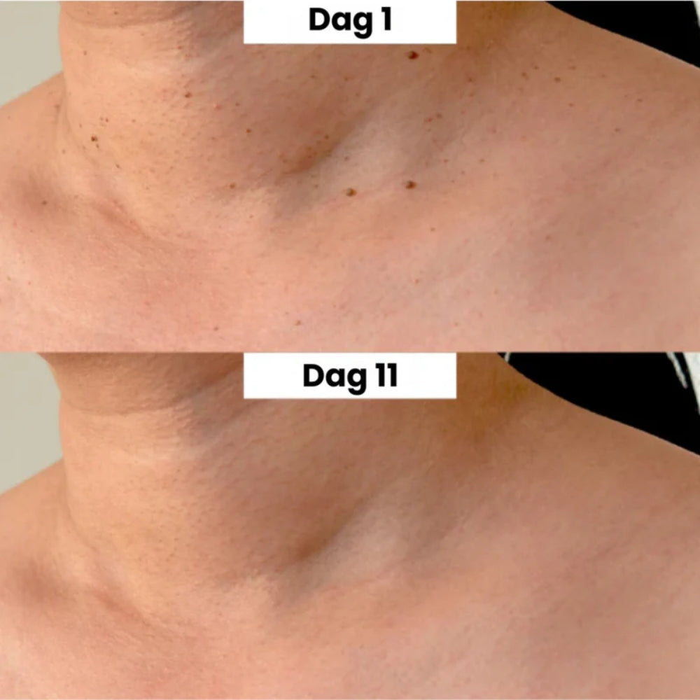 HudRen™penn | Säker borttagning av hudmärken!