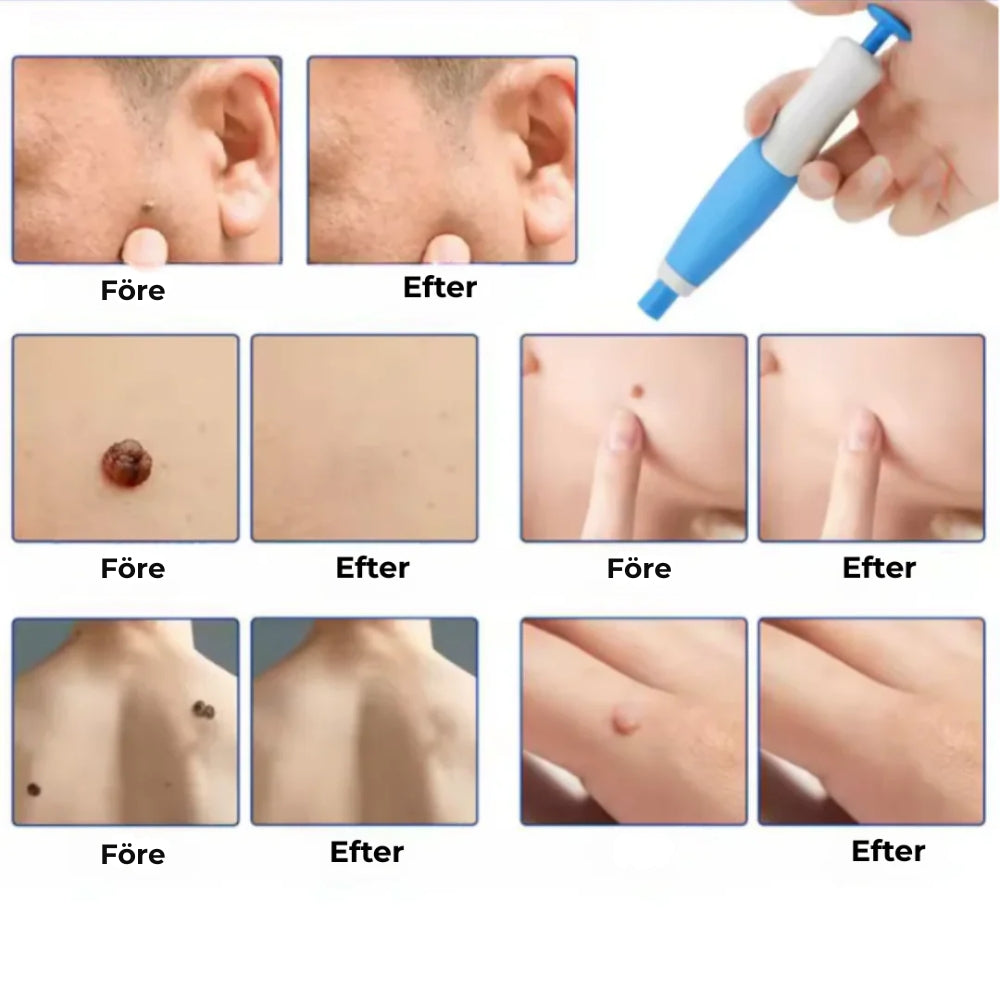 HudRen™penn | Säker borttagning av hudmärken!