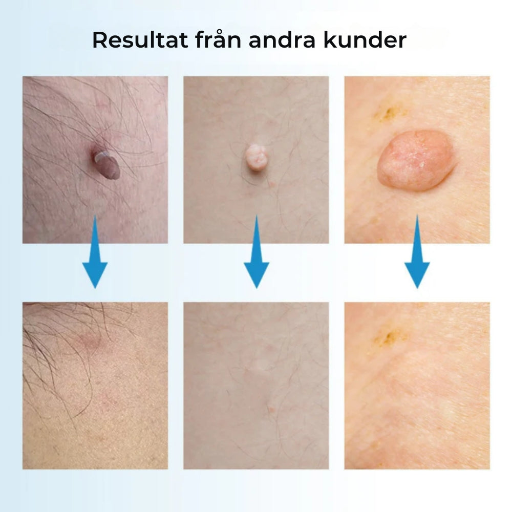 HudRen™penn | Säker borttagning av hudmärken!