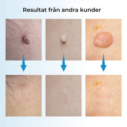 HudRen™penn | Säker borttagning av hudmärken!